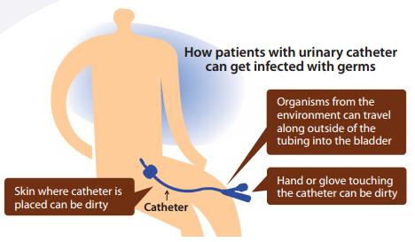 A catheter-associated urinary tract infection (CAUTI) can occur when bacteria or other germs travel along a urinary catheter, resulting in an infection in your bladder or your kidney.