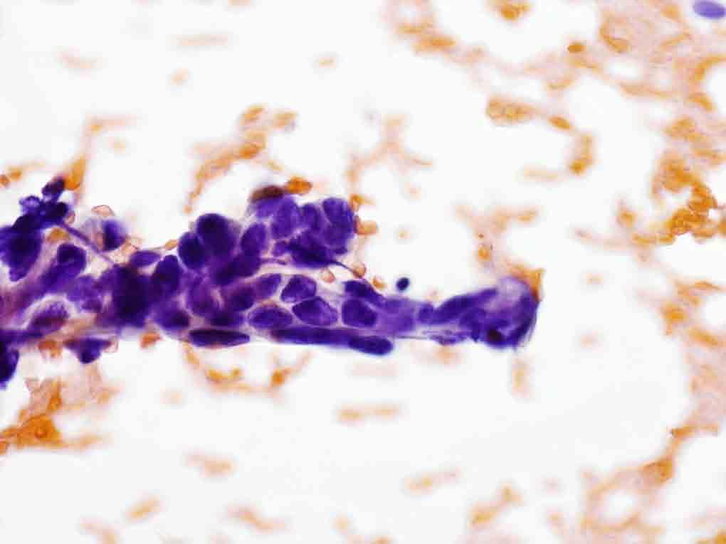 Liver, ultrasound-guided FNA: Papanicolaou stain, 40x Presentation material is