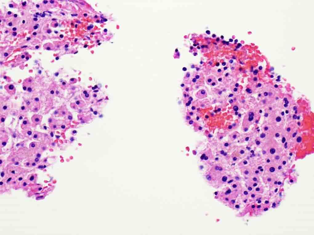 Liver, cell block: Hematoxylin and eosin stain, 20x Presentation material is for