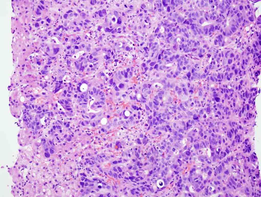 Liver, right, core needle biopsy: H & E stain, 10x Presentation material is for