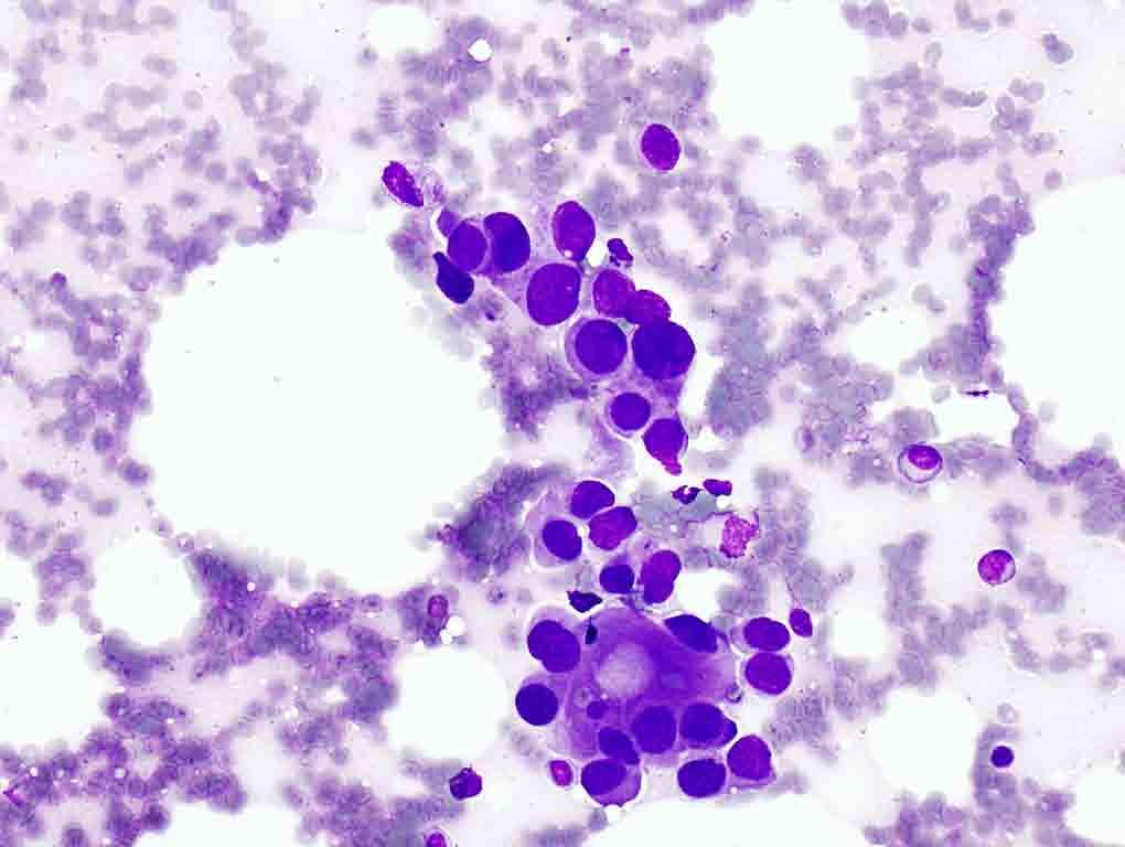 Bone, vertebrae, T12, CT-guided FNA: Diff-Quik stain, 20x Presentation material is