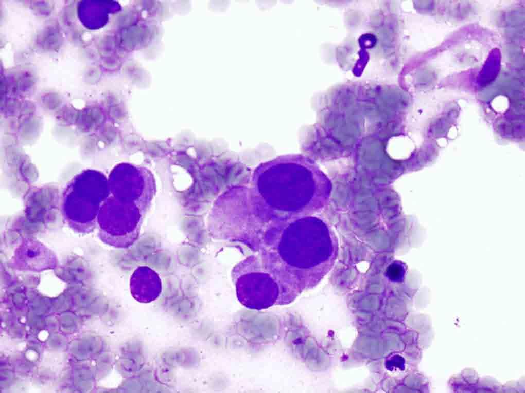 Bone, vertebrae, T12, CT-guided FNA: Diff-Quik stain, 40x Presentation material is