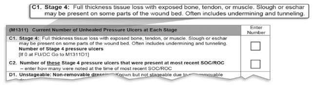Stage 4 Stage 4 Pressure Ulcer 241 242 Exposed bone or eschar May be slough or eschar present, but not obstructing wound bed Undermining or tunneling Granulation indicates healing Osteomye litis does