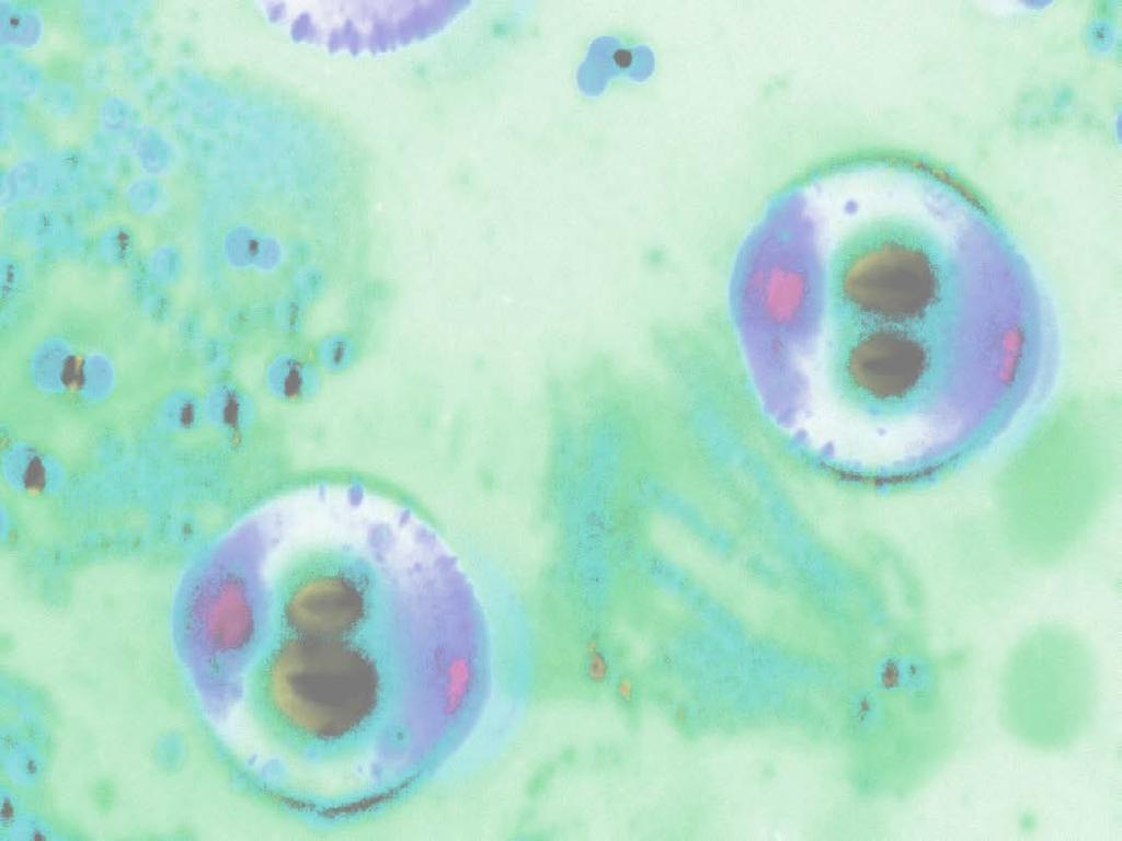 ovirus Cdiff MRSA Norovirus irus R Infection