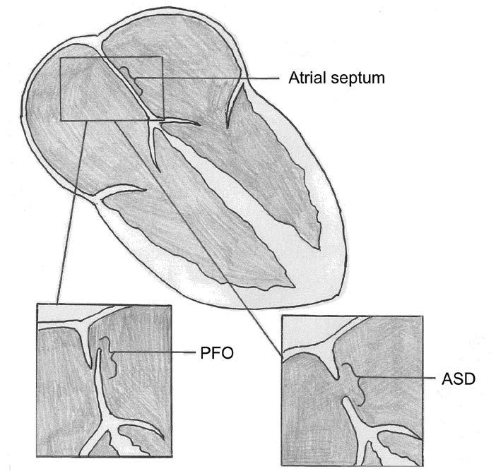 A patent foramen ovale (PFO) and an atrial septal defect (ASD) cause leaks in the atrial septum. How are ASDs and PFOs treated?