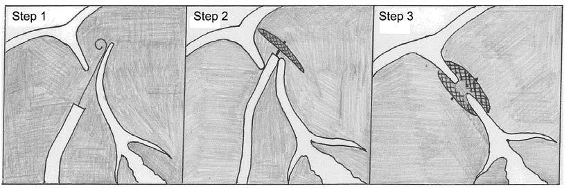 Closing your PFO or ASD involves 3 main steps (see drawing below): 1. Your doctor will insert a catheter through a vein and thread it into your heart.