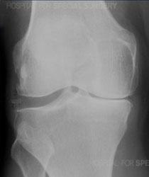 Example Only Patient presents to physio with knee pain Diagnosis/Clinical Finding: OA knee causing decreased mobility