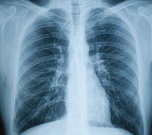 What tests might I have? The lung doctor will ask you about your symptoms and will then examine you.