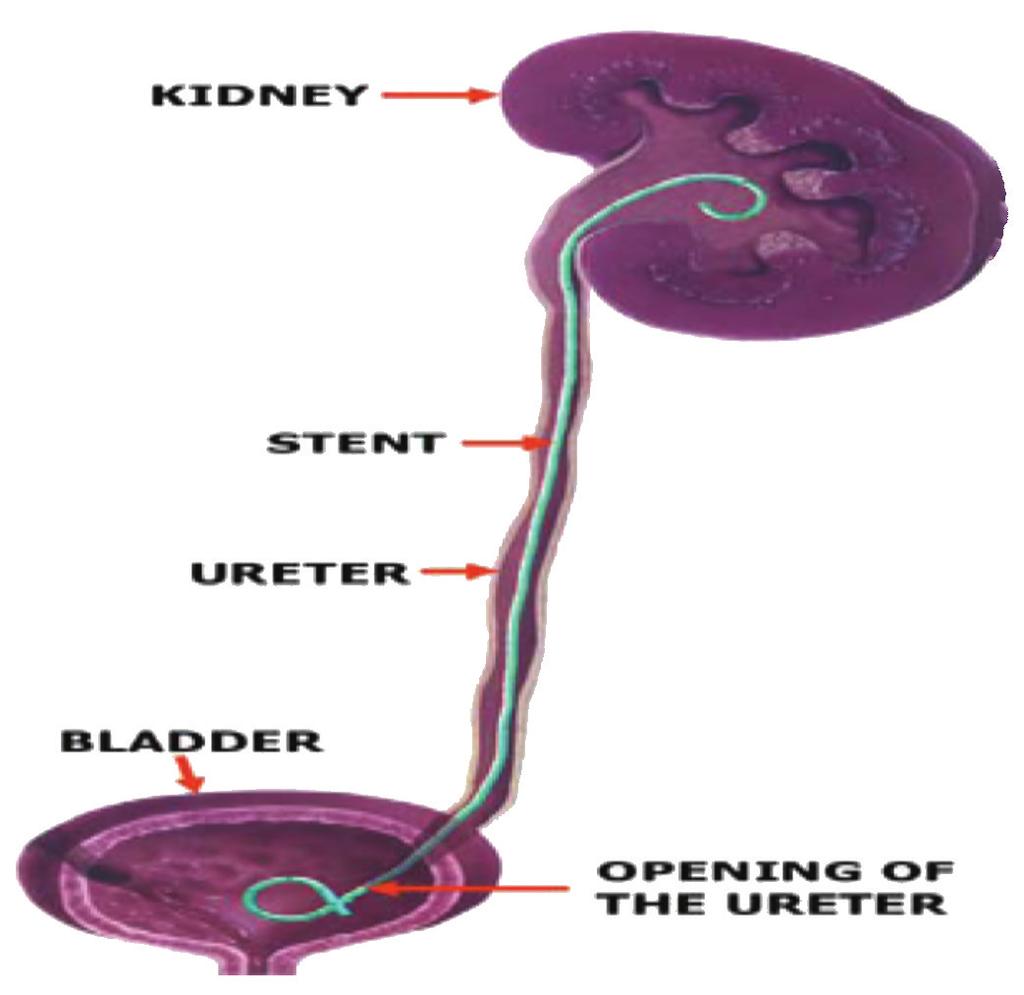 Ureteral Stents Most kidney transplant recipients will have a ureteral stent placed during the operation. What is a ureteral stent?