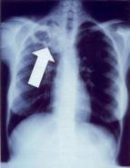 Definitions of abbreviations: AFB = acid-fast bacilli; C/W = consistent with; CXR = chest radiograph; TB = tuberculosis.
