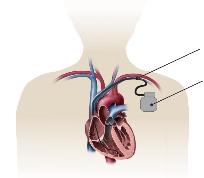 Why a Pacemaker Is Necessary Most patients need a pacemaker because their hearts beat too slowly to meet the needs of their bodies. This is known as bradycardia.