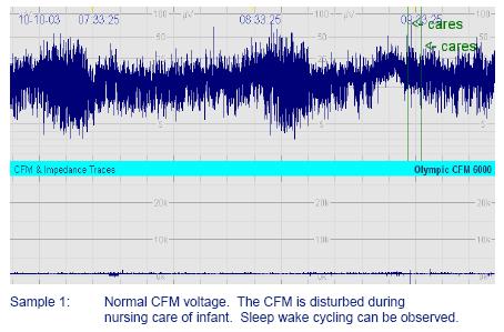 2.6 Interpretation of the CFM Two features of the CFM trace should be assessed: 1. The Amplitude 2. The presence of seizure activity.