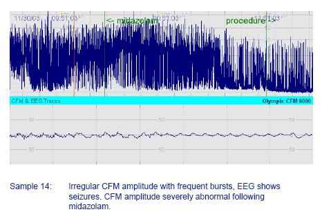 The Presence of Seizure Activity Seizure activity is seen as notches in the band as bursts of higher voltage interfere with the trace.