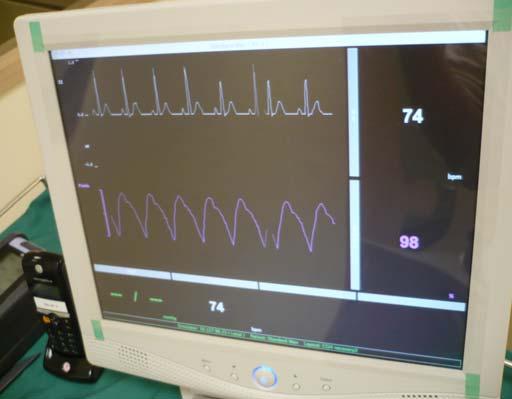 Monitor display The monitor can display the following parameters: ECG (lead II) Heart rate Non-invasive BP Invasive arterial