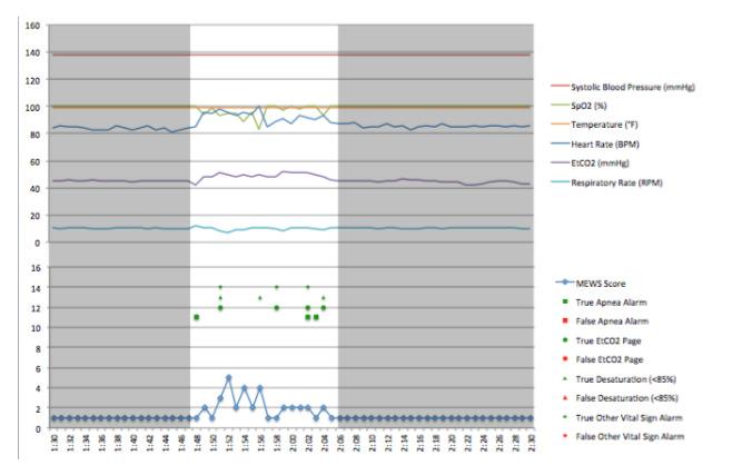 Figure 1: Excerpt from monitoring of 70 y/o female (BMI 43.
