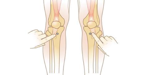 Vascular Access 1101 IO Insertion Site Instructions Proximal Tibia Adults Extend the leg - insertion site is approx.