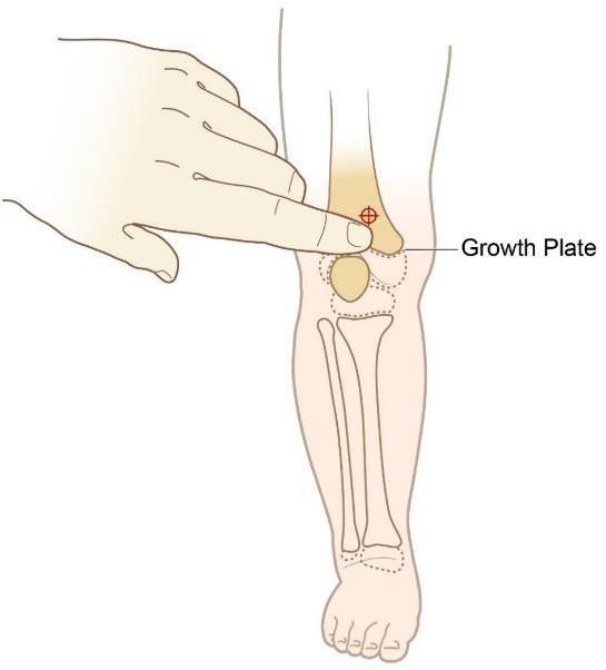 Vascular Access Distal Femur Infants & Small Children Secure the leg out-stretched to ensure the knee does not bend. Identify the patella by palpation.