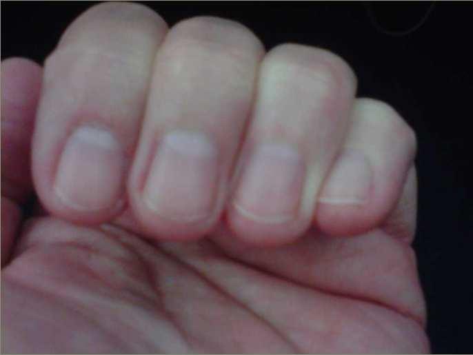 PRESSURE ULCER PREVENTION Keep YOUR nails