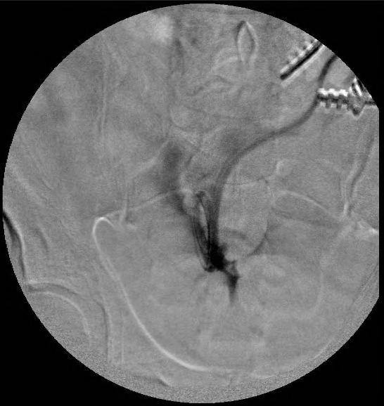 PERCUTANEOUS PD CATHETER PLACEMENT Can be done safely with good long-term patency either by peritoneoscopic or fluoroscopic methods.