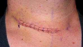 Caring for Your Incision Partial neck incision with staples If sutures/staples are present: Clean 3 times daily or as often as your doctor or nurse order.