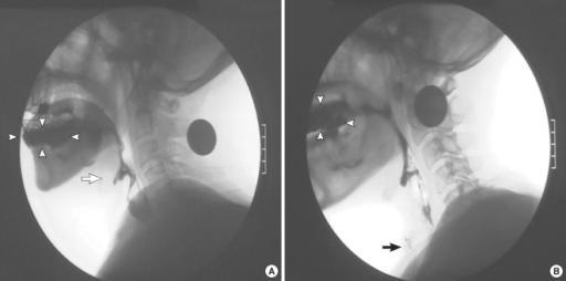 Detection of aspiration Bedside swallowing assessment