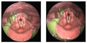 videofluoroscopic swallowing study (VFSS) fiberoptic