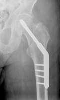There are numerous types of procedures which are performed following a fractured neck of femur, mainly: A Dynamic Hip Screw