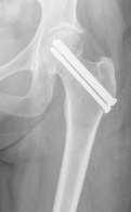 Cannulated Hip Screw which involves fixing two or three screws to secure the fracture site.