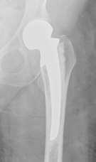 In this fixation the ball part of the ball and socket hip joint is replaced by the prosthesis.
