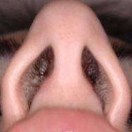 Nasal Decolonization Mupirocin 2% ointment Apply inside each nostril twice daily for 7 days,