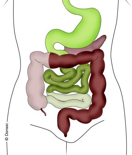 The light shading area on the diagram marked with an arrow below, gives an indication of which part of the bowel is to be removed.