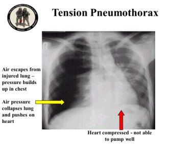 TCCC for All Combatants 1708 Introduction to TCCC Instructor Guide 5 Tension Pneumothorax 13. Air escapes from the injured lung pressure builds up in the chest.