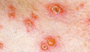 4. Processes and Procedures What causes chickenpox and shingles? Chickenpox and shingles are both caused by the Varicella Zoster Virus.