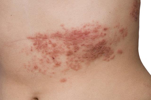 Staff members with chickenpox, shingles or any undiagnosed vesicular rash must not attend work and must seek advice from Occupational Health.