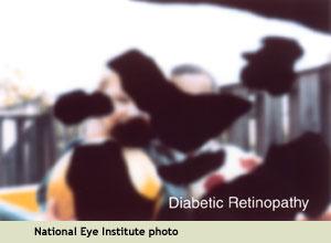 retinopathy: Cataract: