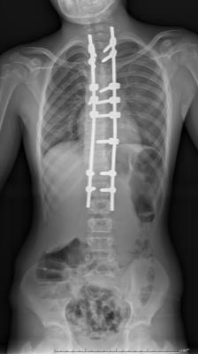 spine and correction of the spine at the same time.