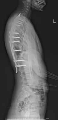 Rod breakage can occur and this is a normal outcome.