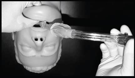 KING LTS-D Airway Procedure KING Airway Insertion Procedure (continued) 3. Test cuff inflation system by injecting the maximum recommended volume of air into the cuffs.