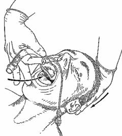 The Laryngeal Mask Airway is an adjunctive airway device composed of a tube with a cuffed mask-like projection at the distal end.