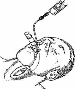 LMA Airway Procedure (ILS & ALS ONLY) 7. With neck flexed and head extended, press the laryngeal mask airway into the posterior pharyngeal wall using the index finger. 8.