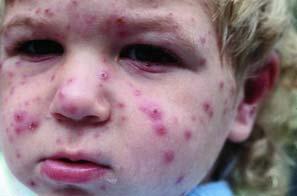 Chickenpox 25 Respiratory secretions, airborne exposures Shingles /Zoster Caused by varicella virus Previously had chickenpox Distribution of pain, along