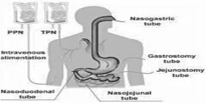 Includes: Nutrition received by: Nasogastric (NG) tube Gastrostomy (PEG tube); Jejunostomy Any other artificial opening into the alimentary canal Excludes: Feeding tube ONLY: Flushed to maintain