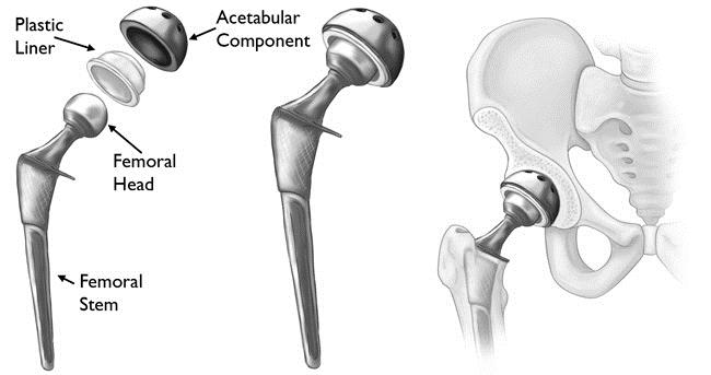 Types of Joint Replacement Surgery Both hip and knee replacement surgeries have become common orthopaedic procedures in the United States to help alleviate conditions caused by osteoarthritis,