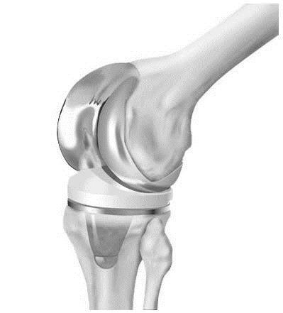 Hip replacements can also be cemented or cementless.