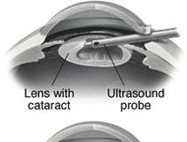 Cataract surgery using ultrasound Cataract surgery using Ultrasound Normally cataract surgery is carried out under local anaesthetic.