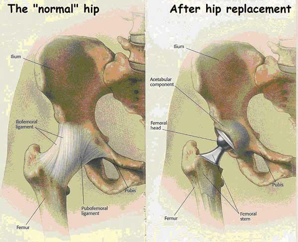 What is a Hip Replacement? Total Hip replacement is surgery done to replace the hip joint with an artificial one.