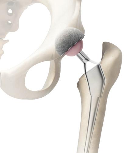 Total hip replacement Total hip replacement is a surgical procedure for replacing the hip joint.