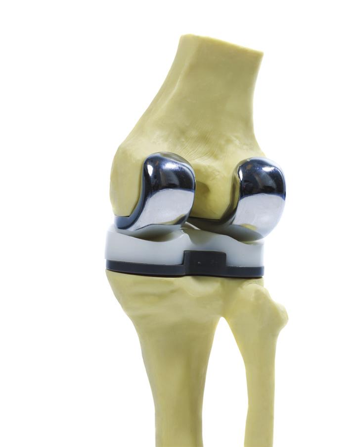 Total knee replacement A total knee replacement is a surgical procedure to replace a diseased knee joint with an artificial joint.