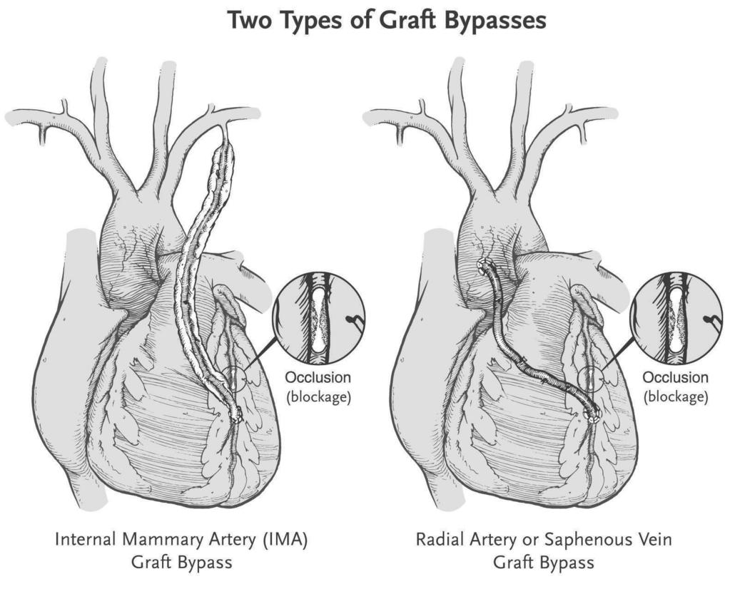 TYPES OF HEART SURGERY Coronary Artery Bypass Graft Surgery Coronary Artery Bypass Graft (CABG) surgery is necessary when medication or other procedures have not been able to improve the blood flow