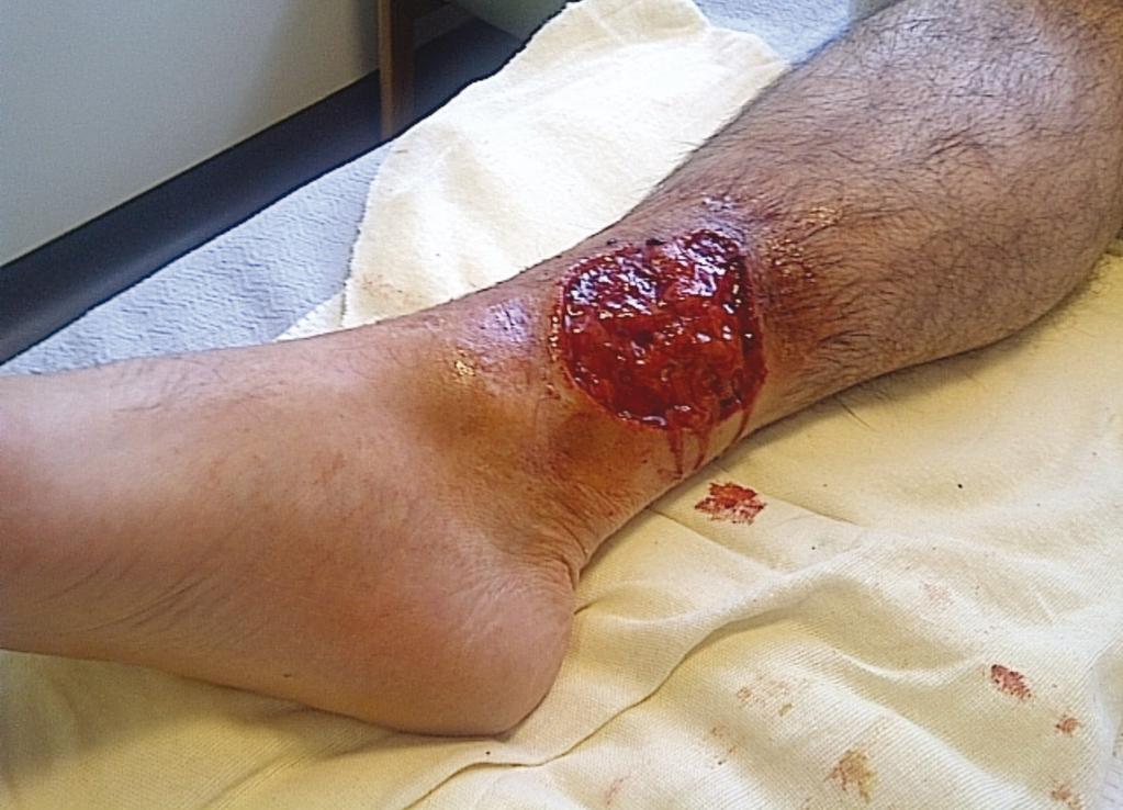 Figure 5: A simulated leg ulcer. group of pharmacists who had noticed her regularly buying large rolls of gamgee.